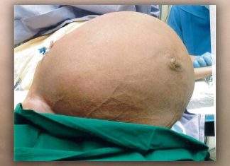 Mulher retira tumor de 27 kg após ter dificuldade para respirar