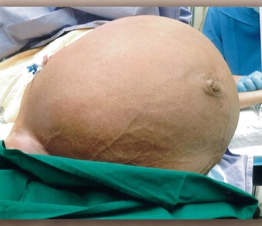 Mulher retira tumor de 27 kg após ter dificuldade para respirar