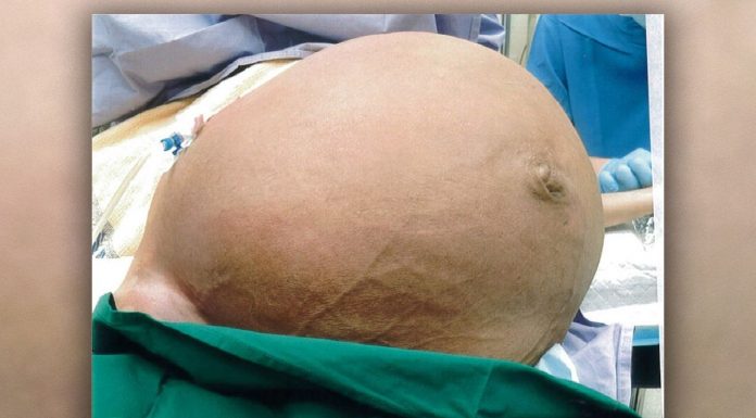 Mulher retira tumor de 27 kg após ter dificuldade para respirar