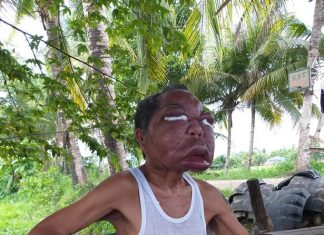 Homem fica com a cabeça gigante após ser diagnosticado com sinusite. VEJA O VÍDEO