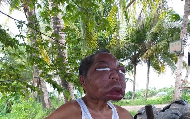 Homem fica com a cabeça gigante após ser diagnosticado com sinusite. VEJA O VÍDEO
