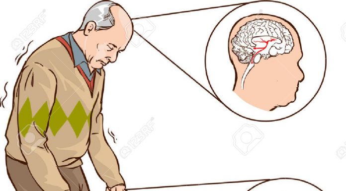 Cientistas descobrem estágios iniciais do Mal de Parkinson
