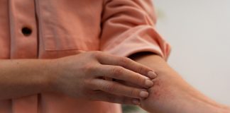 Picadas de insetos: como prevenir e agir em casos de reação alérgica