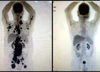 Entenda como funciona a terapia celular CAR-T Cell contra o câncer