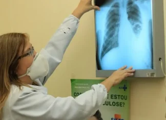 Brasil está na contramão da meta da OMS para extinção da tuberculose