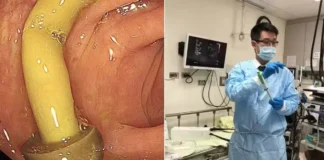 Médico encontra cogumelo crescendo em intestino de paciente