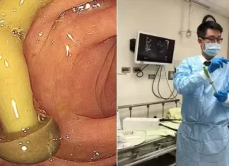 Médico encontra cogumelo crescendo em intestino de paciente