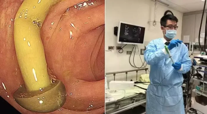 Médico encontra cogumelo crescendo em intestino de paciente