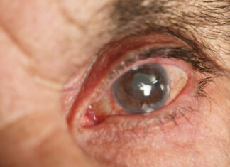 Exames periódicos de glaucoma podem evitar a cegueira