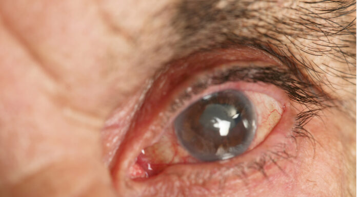 Exames periódicos de glaucoma podem evitar a cegueira
