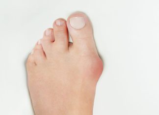 Há séculos, o joanete causa dores e deformidades nos pés