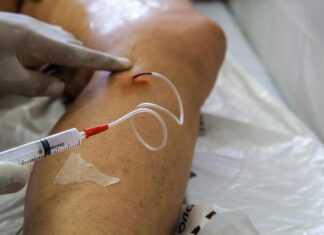 Pandemia fez cirurgias de varizes pelo SUS despencarem 69% no país
